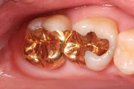 INLAY DE METAL