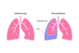 Image result for Thoracentesis