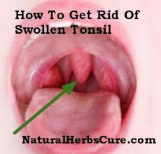 Home Remedies Swollen Tonsil Remedies For Swollen Tonsils Swollen Tonsils Tonsilitis Remedy