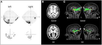 Image result for Visual Field Deficit