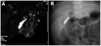 We did not find results for: Three Dimensional Magnetic Resonance Cholangiopancreatography For The Diagnosis Of Biliary Atresia In Infants And Neonates