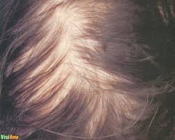 Low thyroid function can be one of the main reasons for hair loss. Stop Hormone Related Female Hair Loss Naturally Visihow