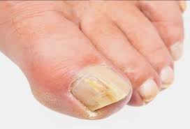 Image result for Yellow nail syndrome feet