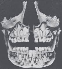 X Rays Of Kid S Skulls As Their Baby Teeth Get Pushed Out Canine Tooth Childs Skull Teeth