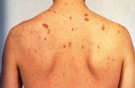 Image result for cka hiv sida