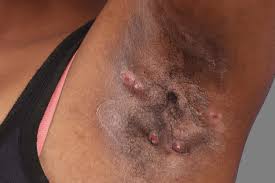 Image result for sore skin in the groin area