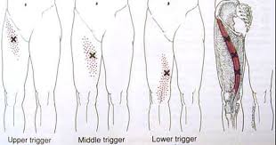 Category Psoas Release Trigger Points Massage Therapy