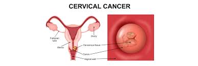 Image result for Cervical Cancer
