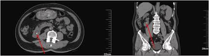 Image result for Nephrolithiasis Imaging