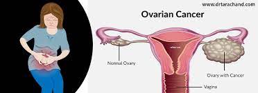 Because the signs of ovarian cancer are common and somewhat vague, it's hard to know when to call the doctor. Ovarian Cancer Treatment In Jaipur By Dr Tarachand Cancer Specialist