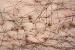 Groin Area Pubic Lice