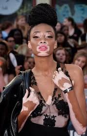 Black And White Skin Condition Model Pin By Michelle Bissainthe On Untame Vitiligo Model Chantelle Brown Young Winnie Harlow