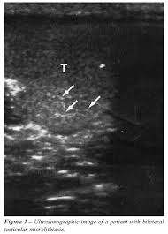 According to breastcancer.org, lumps are. Scielo Brasil Association Between Testicular Microlithiasis Testicular Cancer Cryptorchidism And History Of Ascending Testis Association Between Testicular Microlithiasis Testicular Cancer Cryptorchidism And History Of Ascending Testis