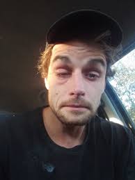 Question has anyone had people comment that you look lime someone punched  you in the eye when you have a migraine? My brother told me this yesterday.