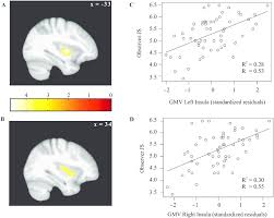 Observer Justice Sensitivity Is Positively Associated With