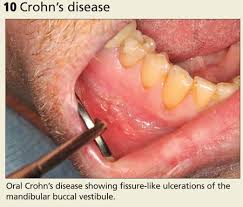 Oral Lesions You Can T Afford To Miss Clinician Reviews