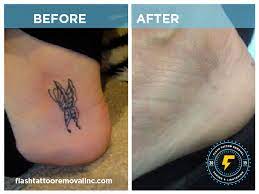 Facials, microblading, weight loss, acupuncture, laser hair removal, mole removal, tattoo removal, acne scars, vein removal in yyc Flash Tattoo Removal Inc Laser Tattoo Removal Fading Calgary