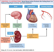 Schrier rw, gottschalk cw, eds. Renal Denervation Prevents Heart Failure Progression Via Inhibition Of The Renin Angiotensin System Journal Of The American College Of Cardiology