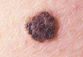 Bootswebmd Gp Reviewed Health Information For The Uk Skin Diseases Itching Skin Best Eczema Treatment