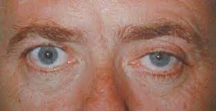 Anhidrosis is known by many other names like hypohidrosis, oligohidrosis, sweating deficiency, decreased swaeting, ischidrosis, oligidria and adiaphoresis. Internal Medicine On Twitter Horner S Syndrome Components Map Miosis Anhydrosis Ptosis Http T Co Ruhdlr8scz