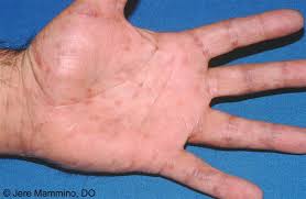 Mar 26, 2019 · syphilis is a sexually transmitted infection (sti) caused by a type of bacteria known as treponema pallidum. Syphilis American Osteopathic College Of Dermatology Aocd