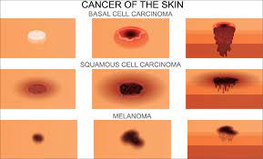 Very rarely, basal cell carcinoma may spread (metastasize) to nearby lymph nodes and other areas of the body. Basal Cell Carcinoma Aapc Knowledge Center