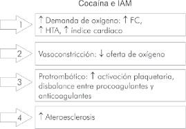 Os sintomas incluem desconforto torácico com ou sem dispneia, náuseas e diaforese. Fisiopatologia Del Infarto Agudo Del Miocardio En Presencia De Cocaina Download Scientific Diagram