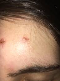 Image result for yellow scabs on the face in children