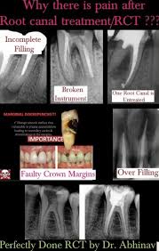 We did not find results for: Is It Okay To Still Have Pain A Month After A Root Canal Treatment Quora