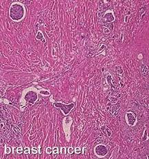 Sometimes people are so frightened about what a doctor will tell them that they don't go to the doctor. Stages Of Breast Cancer And Disease Progression Moose And Doc