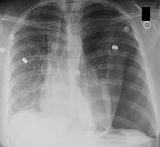 Image result for Pneumothorax
