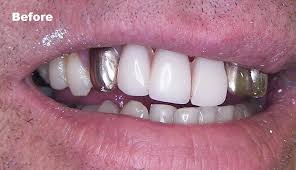 Often, front teeth crowns cost slightly more than back teeth, since more time is taken in the lab to make them look as natural as possible. Gold Tooth Gold Tooth Cap Gold Crown Tooth Gold Teeth Caps Front Teeth Br Deva Dental Clinic