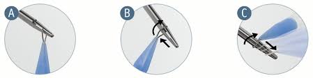Sistem 28 matawang welcome : Lynx Suprapubic Mid Urethral Sling System Boston Scientific
