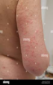 Image result for Polymorphous Light Eruption