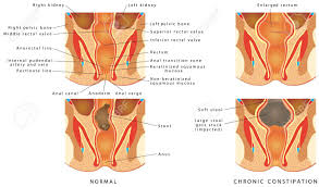 However, treatment is often easy once the bowel obstruction problem and its severity have been identified. Stool Stuck In Intestines Stools Chairs