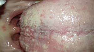 Image result for Puchýře na jazyku