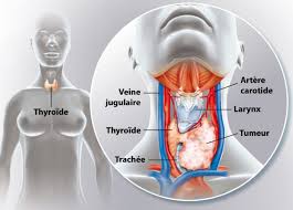 Si le kyste rompu est de type fonctionnel, vous pouvez le traiter à la maison. Comment Savoir Si J Ai Un Cancer De La Thyroide Ramsay Sante