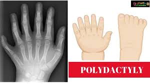 Image result for Polydactyly