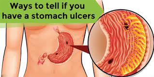 How you treat your throat ulcer will depend on what's causing them. Shilajit For Ulcer Ulcer Symptoms Treatment Home Remedies