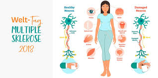 Jul 20, 2021 · die multiple sklerose (ms) ist eine der krankheiten mit vielen gesichtern. M Mann Pa Twitter Doc Mo Video Ms Multiple Sklerose Symptome Diagnose Und Therapie Mehr Zum Welt Ms Tag 2018 Unheilbar Optimistisch Https T Co S21bob5akh Multiplesclerosis Zks Ms Dmsg Bv Https T Co Aq1i3bki4g