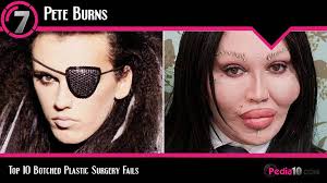 Since then, he's worn a prosthetic nose to hide the huge. Top 10 Botched Plastic Surgery Fails Before And After Album On Imgur