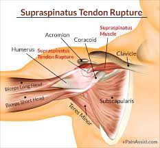 Repair of the tendon or revision of the prosthesis into reverse total shoulder arthroplasty. Supraspinatus Rupture Treatment Causes Symptoms Diagnosis Supraspinatus Muscle Muscle Anatomy Massage Therapy