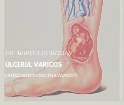 Tratamentul chirurgical pentru vindecarea unui ulcer este rareori utilizat. Ulcerul Varicos Este Reprezentat Dr Marina Dumitras Chirurg Facebook