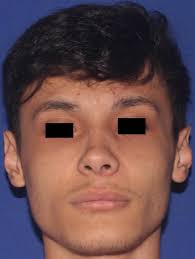 As lesões fibro-ósseas benignas se caracterizam pela substituição do osso  normal por tecido conjuntivo composto por colágen