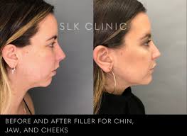 Before and After Photos of Fillers in Nashville
