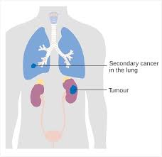 Learn more about common lung cancer symptoms. Secondary Lung Cancer