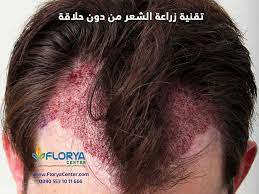 عمليات زراعة الشعر من دون حلاقة تعتبر تقنية زراعة الشعر من دون حلاقة هي أكثر عمليات التجميل انتشار بهذا الوقت وهي عمليات الهدف منها واحد وهو نقل لبصيلات الشعر