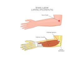 Getting shots of steroid medicine, such as cortisone. Tennis Elbow Lateral Epicondylitis Elbow Specialists Boise Meridian Nampa Treasure Valley