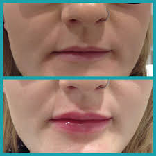 What to expect after a cosmetic injection with dermal fillers? Lip Fillers By The Skin Nurse Teddington Richmond And Sw London