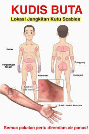 Hilangkan kudis buta tu sekali. Scabies Repellent Spray Anti Kudis Buta Home Facebook